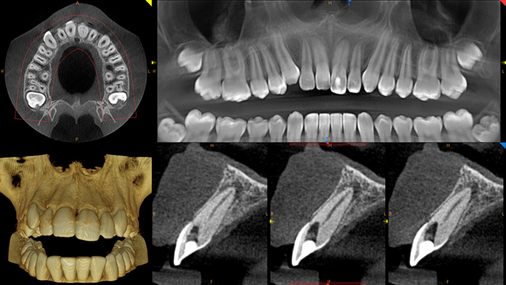 bocca denti